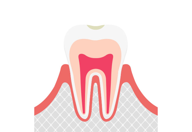 初期のむし歯