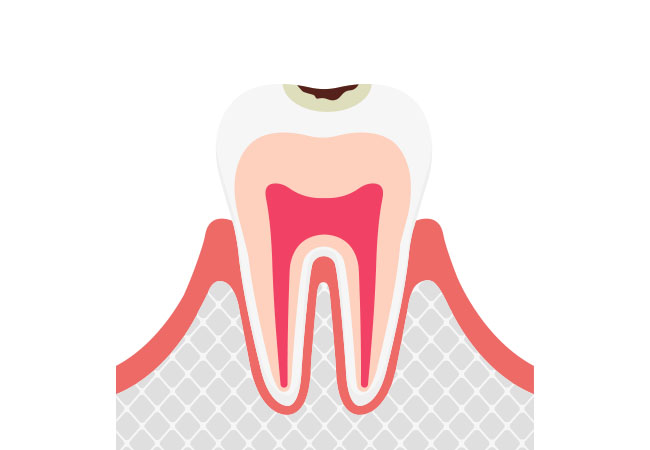小さな穴が開いたむし歯