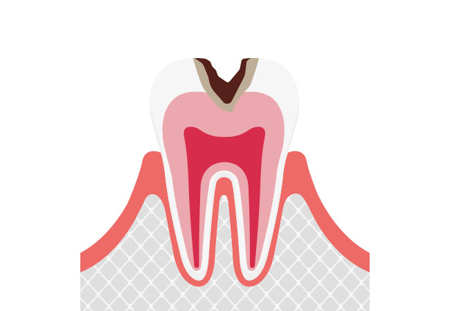 象牙質まで進行したむし歯