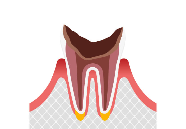 歯根まで進行したむし歯
