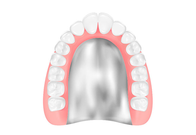 金属床義歯