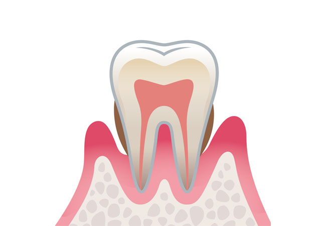 中度歯周病